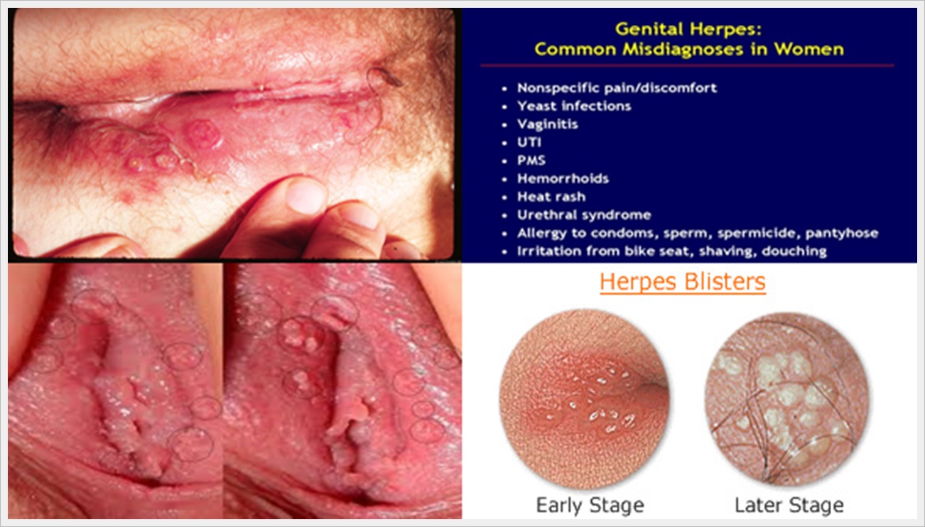 What are the symptoms of herpes simplex, careers in alternat. 