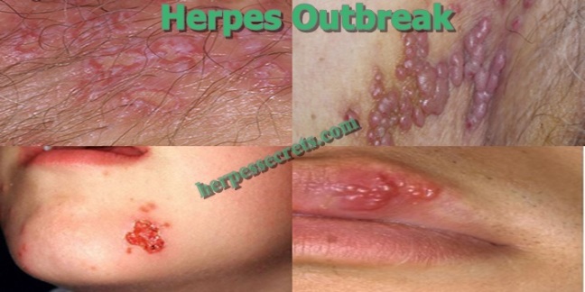 Pictures of Herpes and Genital Herpes - HerpesOnline ...
